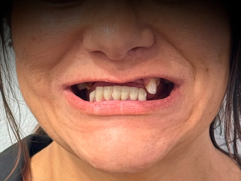 Patient 1 before